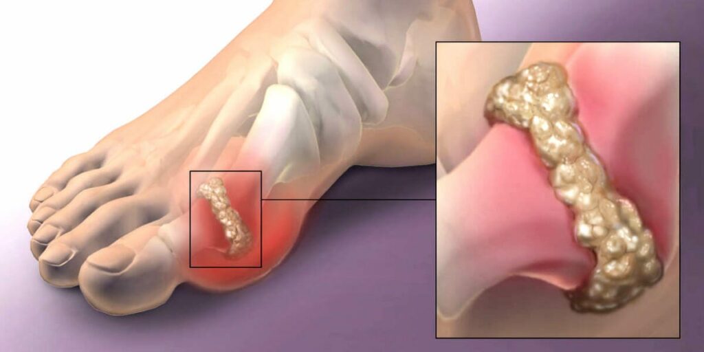 How to lower uric acid levels naturally