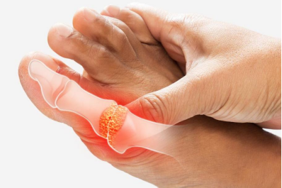 Living with Gout: A Comprehensive Guide to Managing Your Health