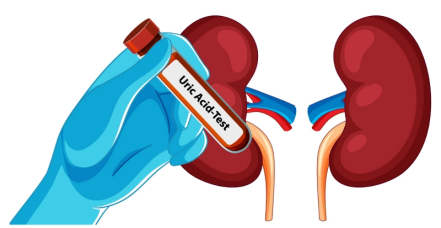 Beyond Gout: The Hidden Dangers of High Uric Acid and Why Testing Matters