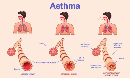Airway Inflammation: The Hidden Fire Inside Your Lungs