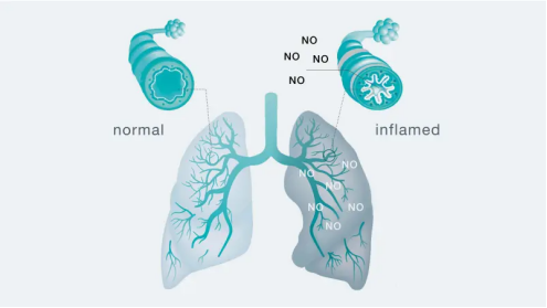 FeNO in Respiratory Diagnostics: A Modern Approach to Airway Inflammation Assessment