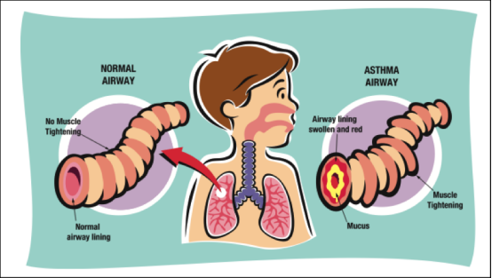 Diagnosing Asthma in Children: A Guide for Parents