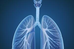 Understanding Bronchiectasis: A Patient-Friendly Guide