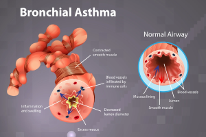 Asthma: The Rising Role of FeNO Testing in Modern Diagnosis