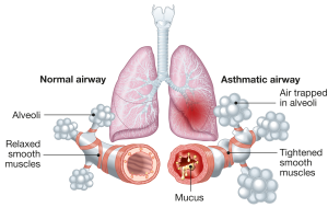 Breathe Easy: How a Simple Breath Test Is Transforming Asthma Diagnosis
