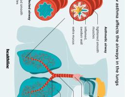 Breath That Tells a Story: How FeNO Testing Helps Diagnose Asthma