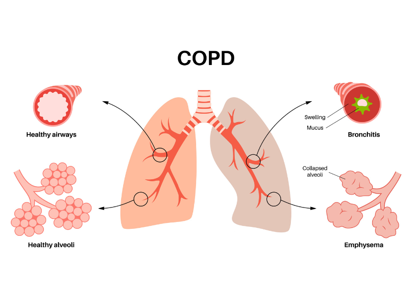 Understanding COPD: A Breath of Knowledge for Better Lung Health